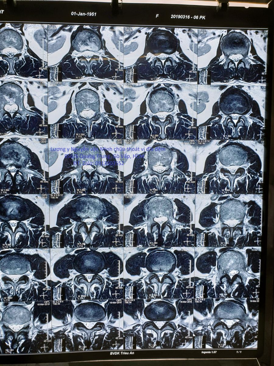 Thoát vị đĩa đệm chèn dây thần kinh